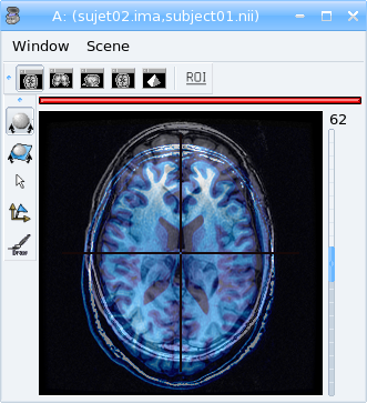 Fusion between anatomical MRI of 2 subjects
