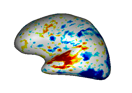 Fusion between an inflated cortical surface mesh and an activation map.
