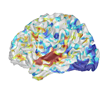 Fusion between a cortical surface mesh and an activation map